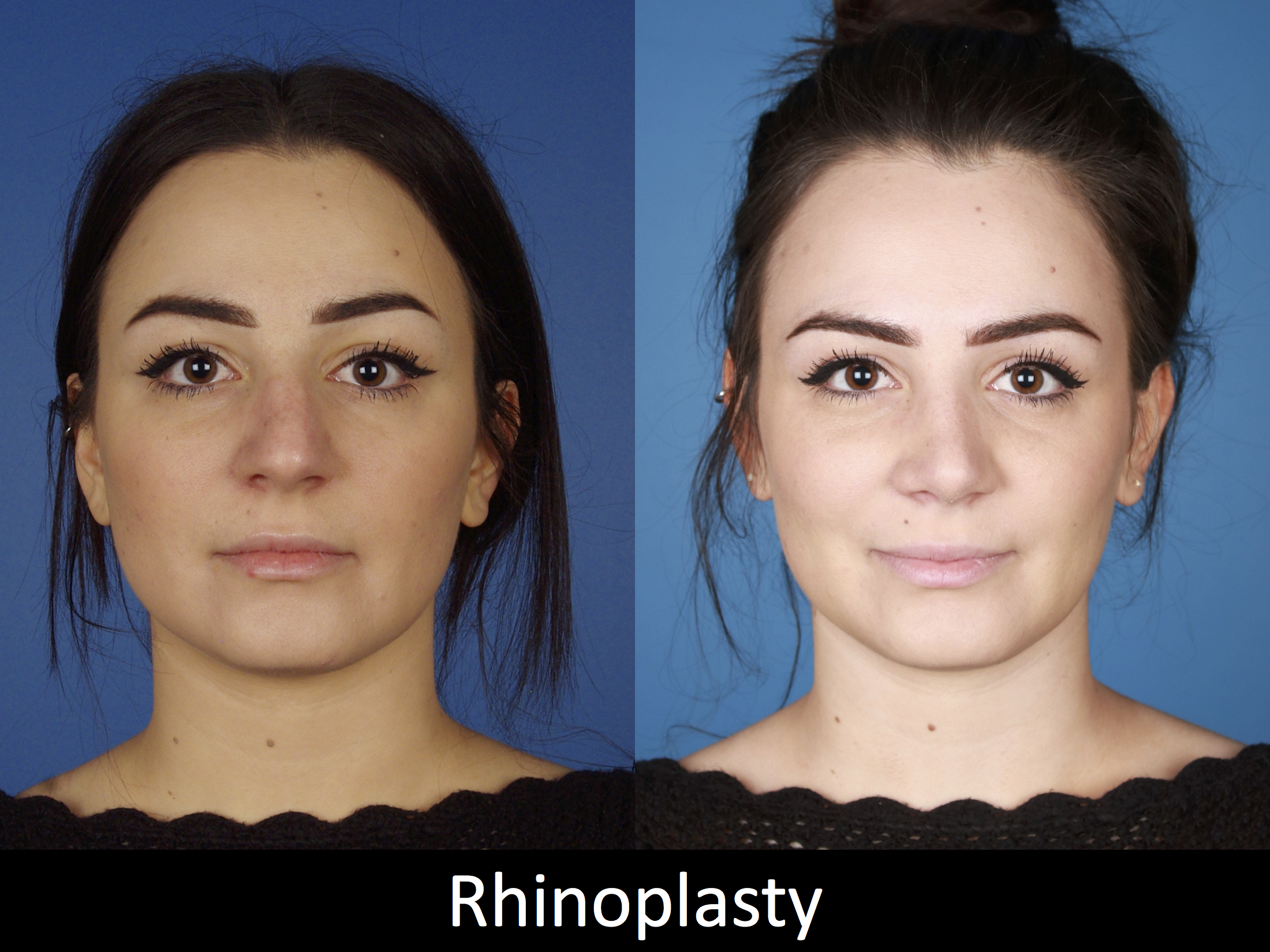 Denver Rhinoplasty Before And Afters Raval Facial Aesthetics